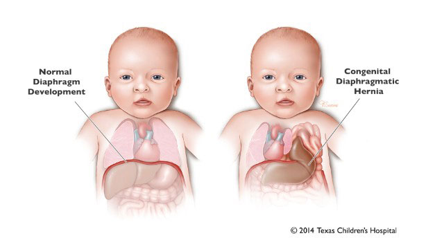 hernia diafragma
